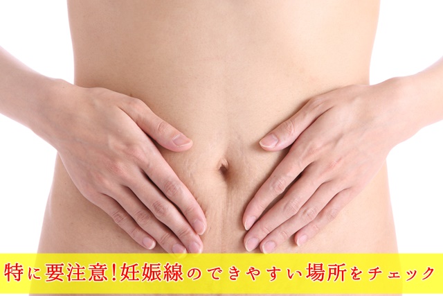 妊娠線のあるお腹