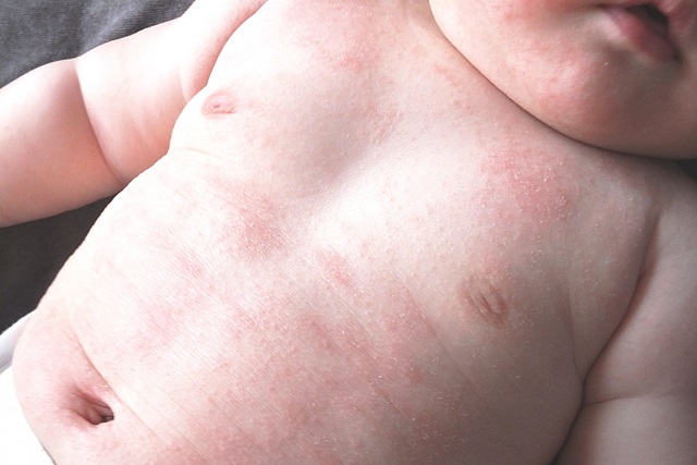 湿疹の赤ちゃん